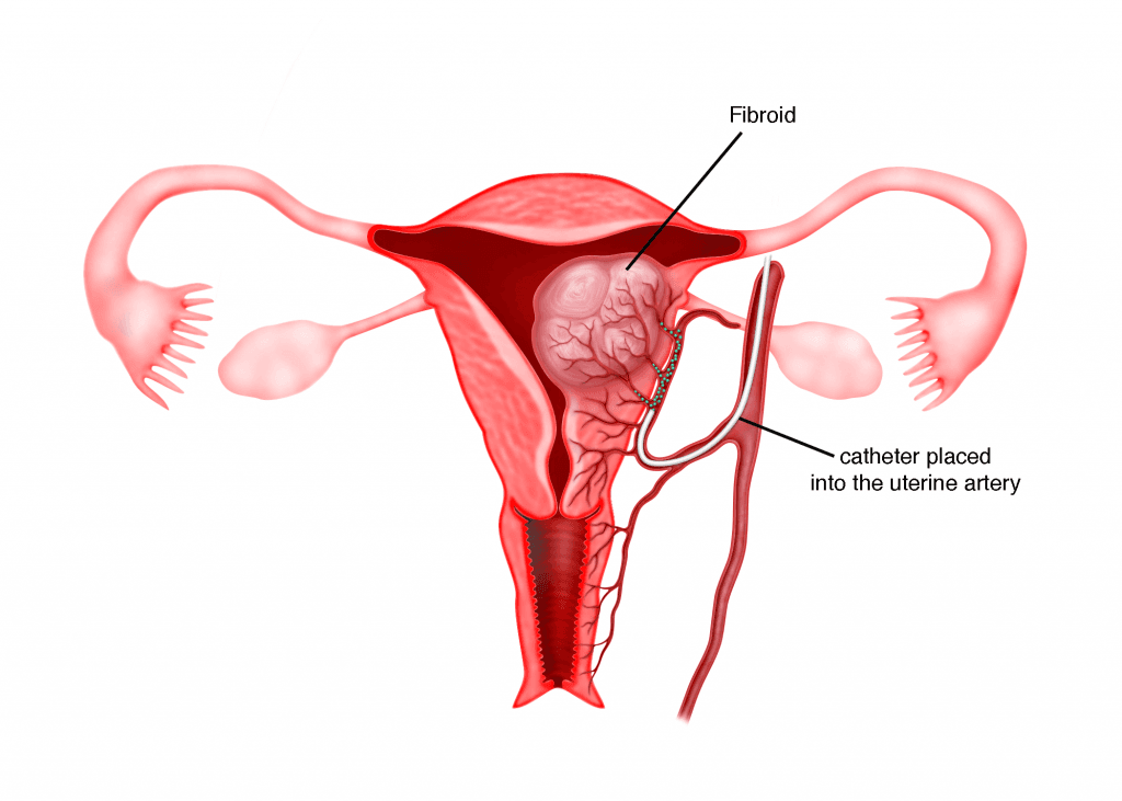 Uterine Fibroids