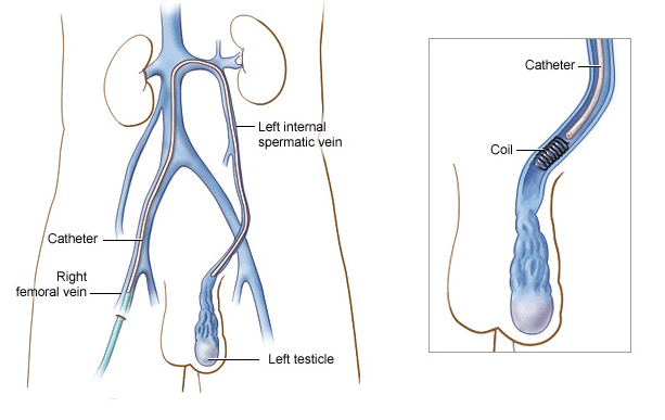 Varicocele Diagram