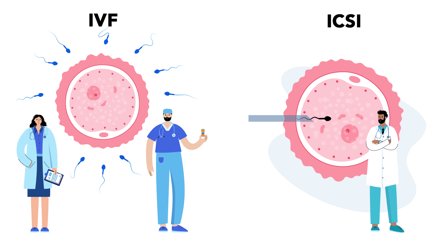 ICSI vs IVF comparison