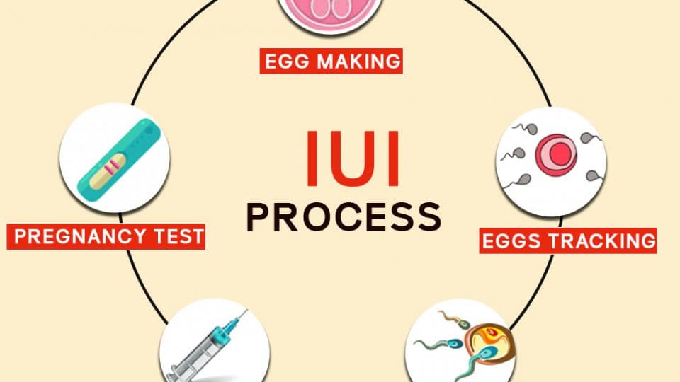 IUI Procedure
