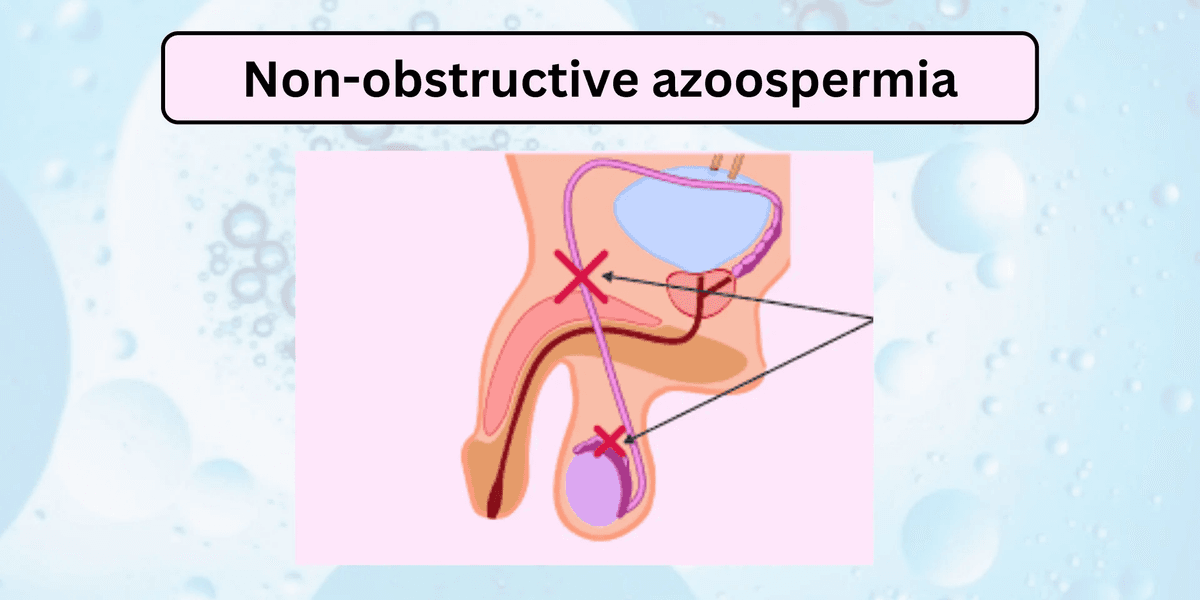 Non-Obstructive Azoospermia