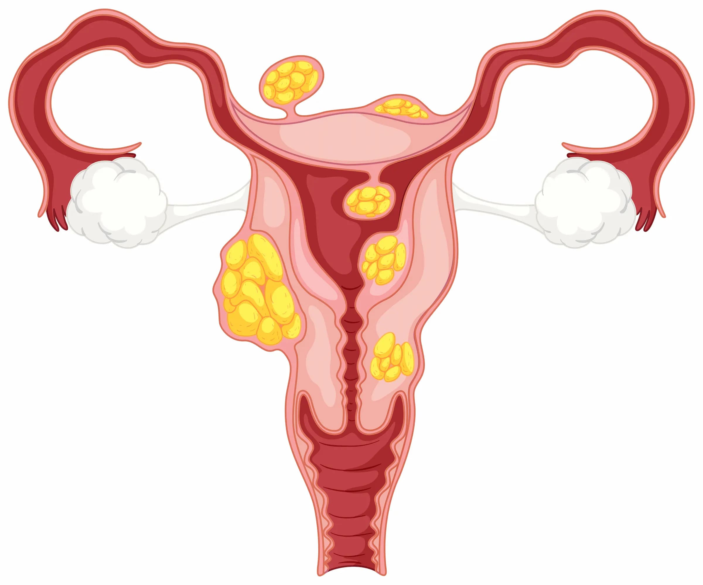 PCOS