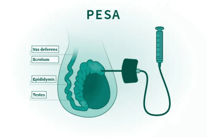 PESA