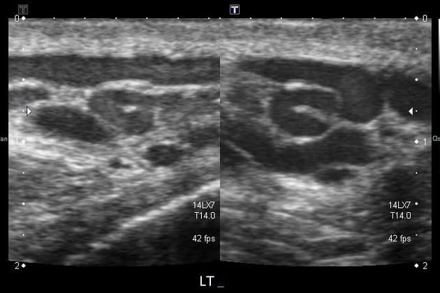 Varicocele Ultrasound